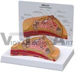 Female Breast Cross-section Model showing common pathologies